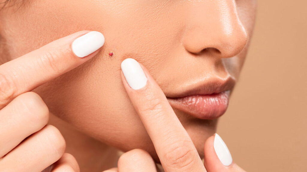 O mito da pasta de dente nas espinhas pode estar prejudicando sua pele

