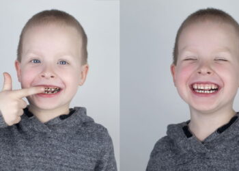 O que significa sonhar com queda de dente segundo a psicologia?