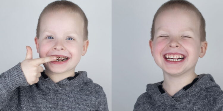 O que significa sonhar com queda de dente segundo a psicologia?