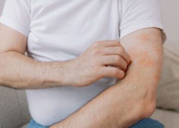 O tipo de alergia mais silencioso e ignorado que afeta milhares de pessoas