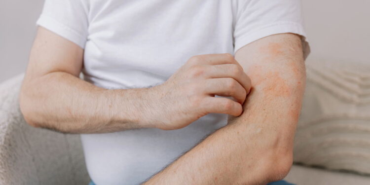 O tipo de alergia mais silencioso e ignorado que afeta milhares de pessoas