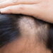 Remédios caseiros que podem ajudar a reverter a alopecia ou queda de cabelo