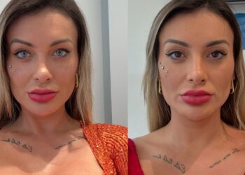 Conheça a cirurgia de mudança de cor dos olhos popular entre as famosas