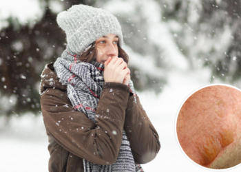 O erro mais comum em queimaduras por frio pode piorar a lesão