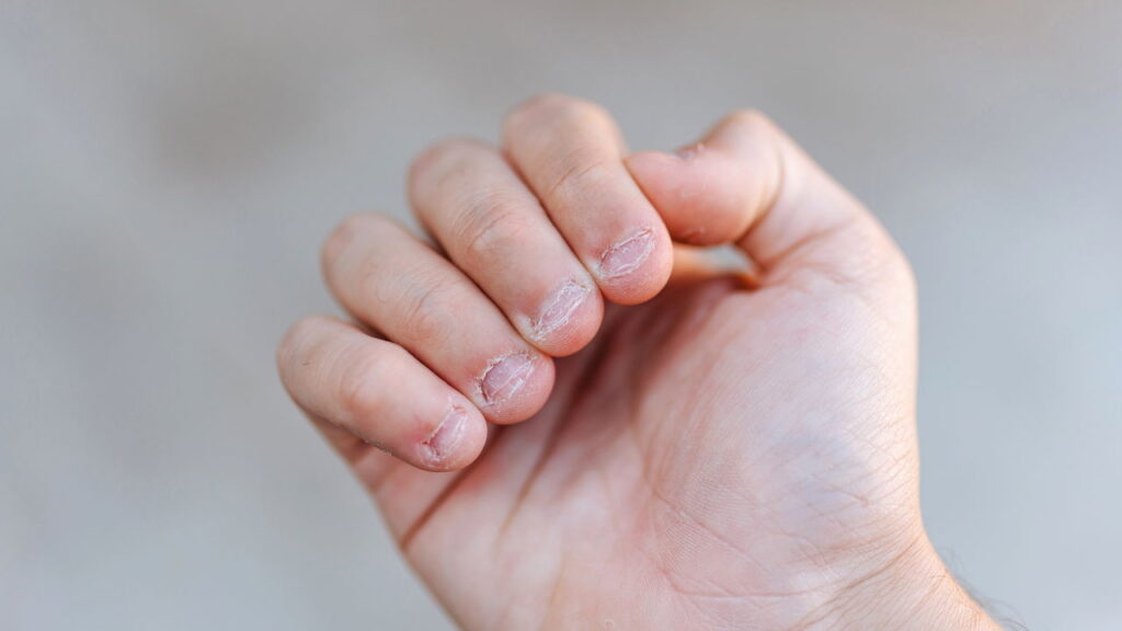 O hábito de roer unhas pode estar ligado à ansiedade, segundo psicólogos