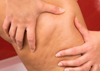 As 3 melhores plantas que combatem celulite com efeitos diuréticos