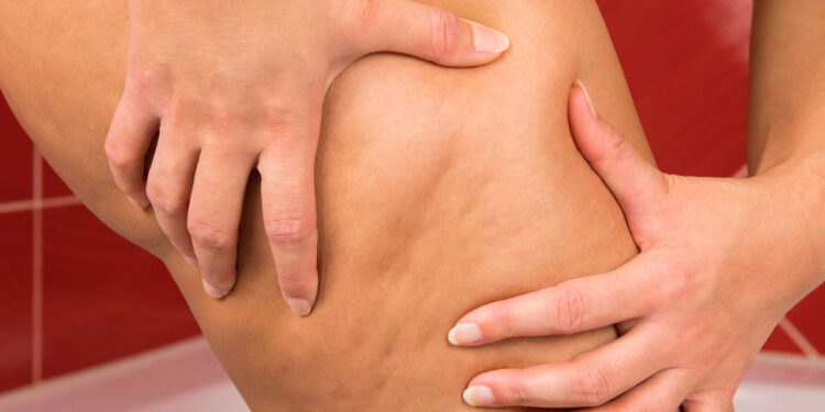 As 3 melhores plantas que combatem celulite com efeitos diuréticos