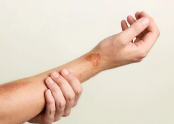 Plantas medicinais que aceleram a cicatrização de machucados