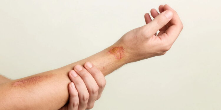 Plantas medicinais que aceleram a cicatrização de machucados