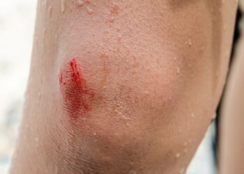 Plantas que ajudam a curar ralados de forma natural e eficaz