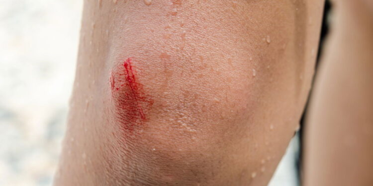 Plantas que ajudam a curar ralados de forma natural e eficaz