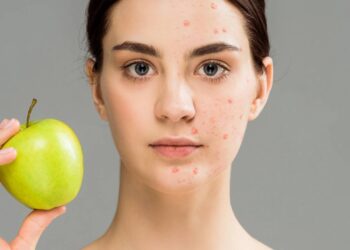 Dicas da nutri para combater acnes com a alimentação