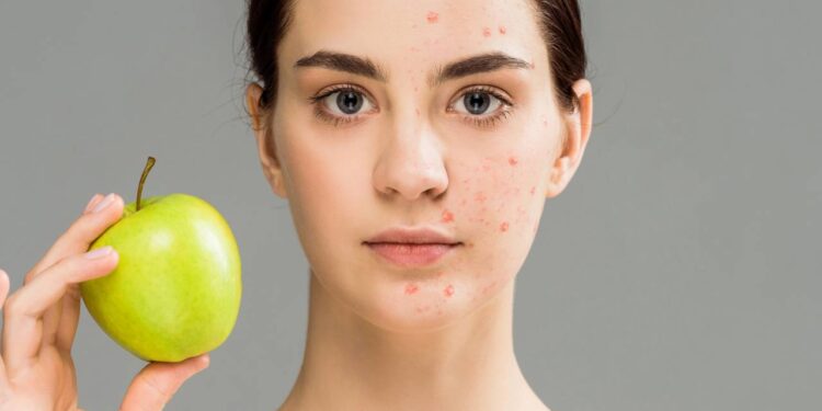 Dicas da nutri para combater acnes com a alimentação