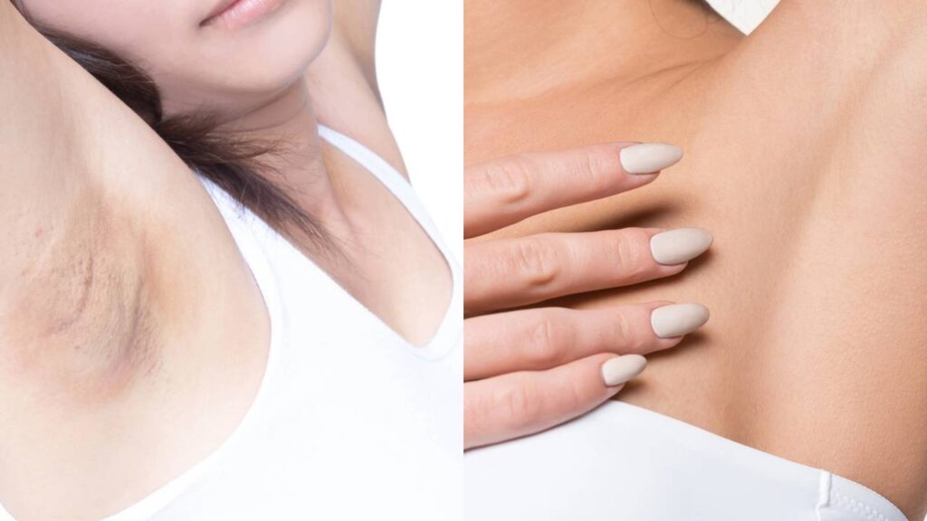 Como clarear a axila em casa apenas com cuidados diários