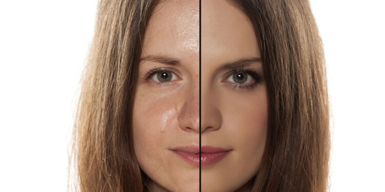 Pele oleosa também precisa de hidratação para ficar equilibrada e saudável