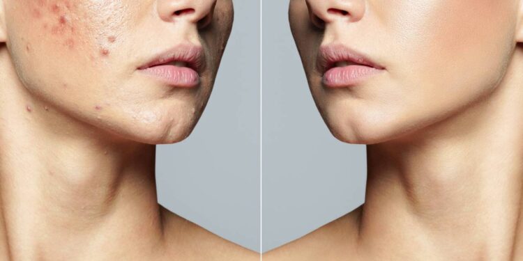 Por que você deve fazer limpeza de pele com profissionais