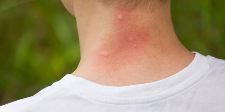 Verão a vista pede truques caseiros para afastar mosquitos e pernilongos para não correr riscos