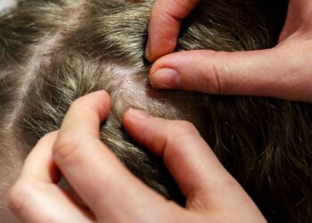 Proteja suas crianças dos piolhos neste verão com truques caseiros que funcionam