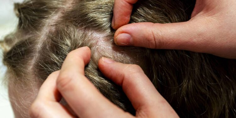 Proteja suas crianças dos piolhos neste verão com truques caseiros que funcionam