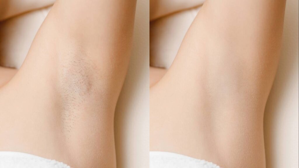 A esfoliação que deixa as axilas mais claras em 7 dias no verão