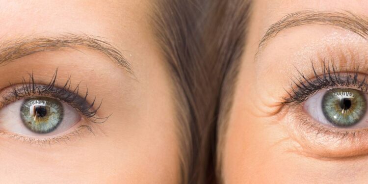 Como reduzir o inchaço dos olhos em casa com técnicas simples