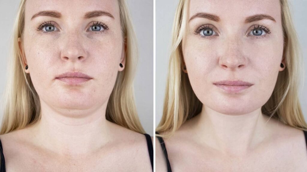 Exercícios faciais caseiros para acabar com a papada naturalmente