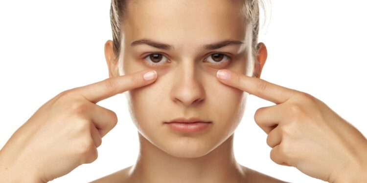 Diga adeus às olheiras mesmo sem noites completas de sono