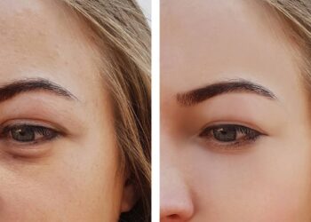 Diga adeus às olheiras mesmo sem noites completas de sono