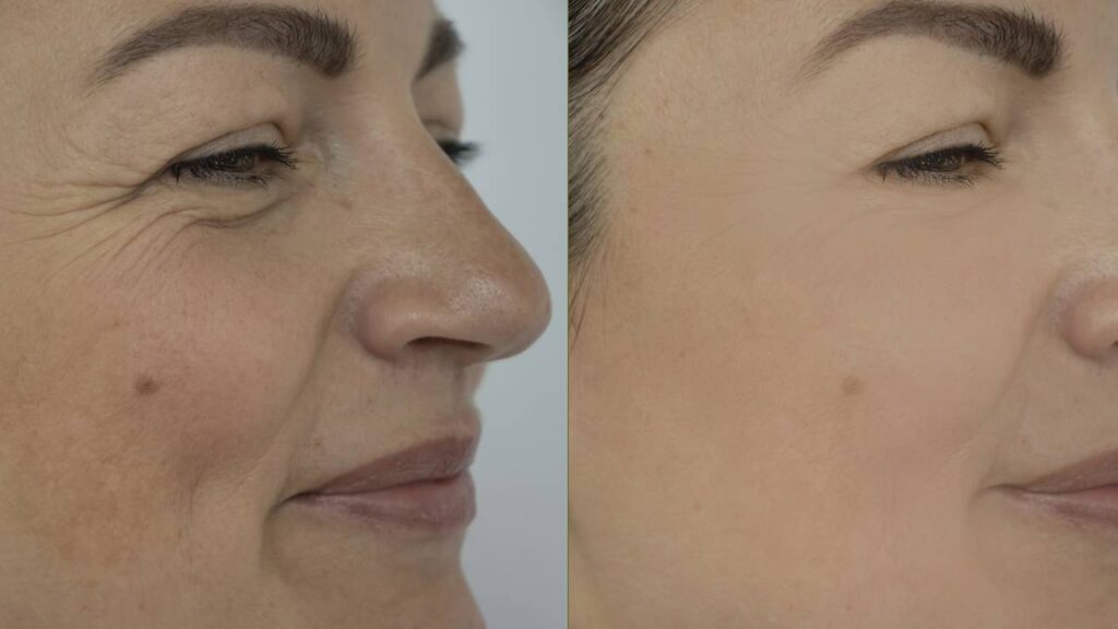 Como lidar com rugas e flacidez na pele, depois dos 45