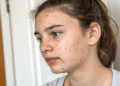 Pele cheia de espinhas? Dermatologistas apontam hábito diário que muitos jovens ignoram