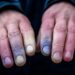 Dedos mudam de cor no frio? Entenda o que pode estar por trás desse sinal estranho