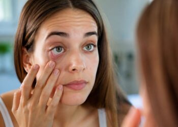 Deficiência de ferro: 3 sinais no corpo que aparecem no espelho e quase ninguém percebe