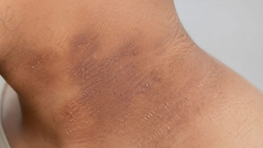 5 sinais na pele que podem indicar diabetes não controlada antes mesmo do diagnóstico médico