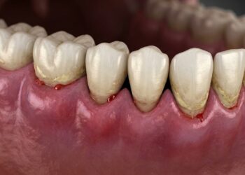 Problemas na gengiva podem indicar inflamação no coração, veja o que observar no dia a dia