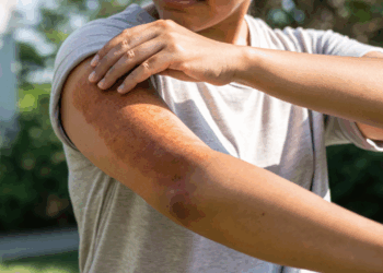 Antes do formigamento a pele já dá sinais de deficiência de vitamina B12 e eles passam despercebidos