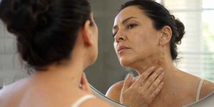 Sintomas de diabetes na pele: as manchas e sinais que podem aparecer antes do diagnóstico