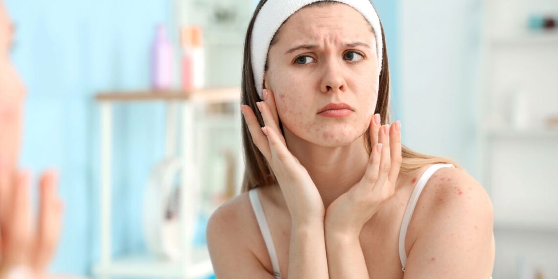 A melhor forma de controlar a acne e manter a pele saudável