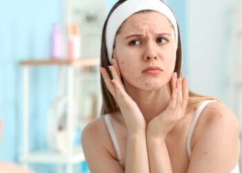 A melhor forma de controlar a acne e manter a pele saudável