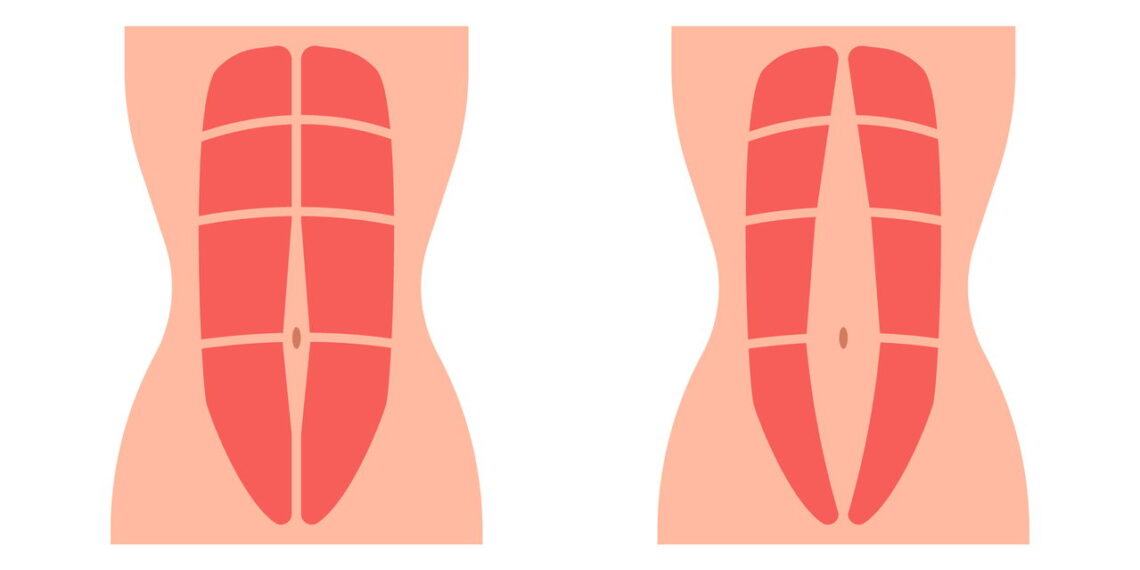 Abdominal de parede é fácil de fazer e ajuda a reduzir barriga rapidamente