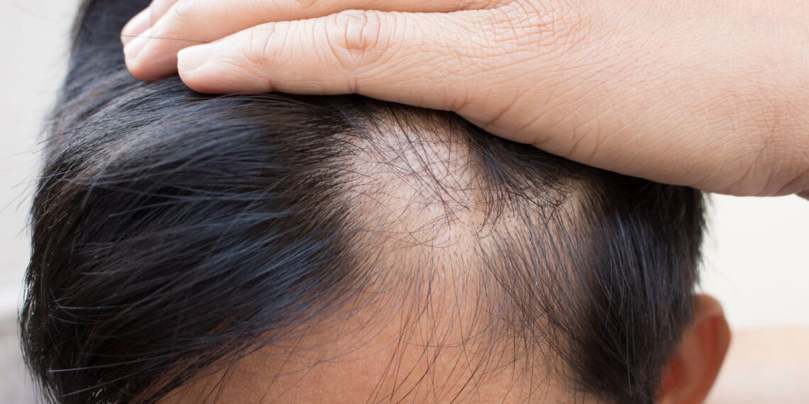 Remédios caseiros que podem ajudar a reverter a alopecia ou queda de cabelo