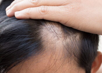 Remédios caseiros que podem ajudar a reverter a alopecia ou queda de cabelo