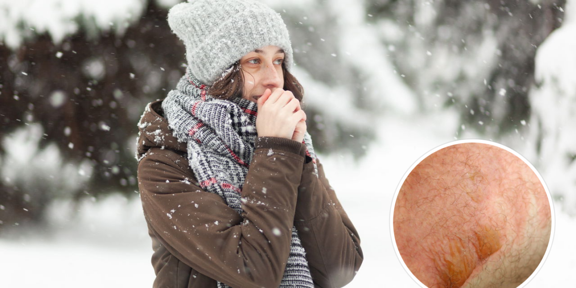 O erro mais comum em queimaduras por frio pode piorar a lesão