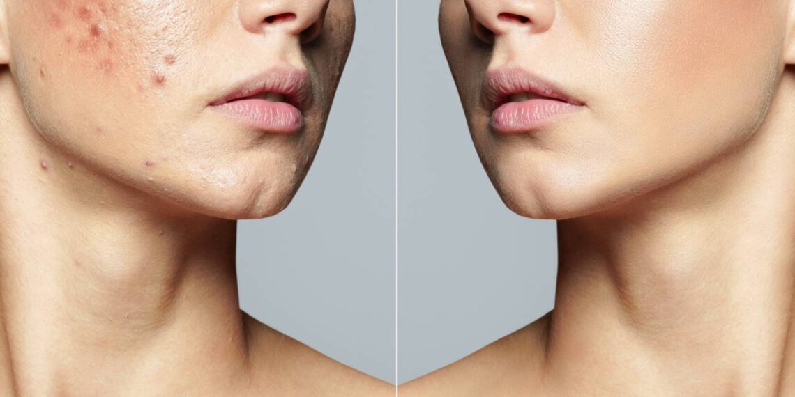 Por que você deve fazer limpeza de pele com profissionais