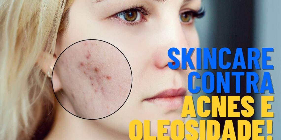 Rotina de skincare eficaz para adolescentes com acnes e pele oleosa