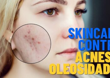 Rotina de skincare eficaz para adolescentes com acnes e pele oleosa
