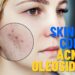 Rotina de skincare eficaz para adolescentes com acnes e pele oleosa