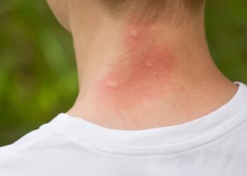 Verão a vista pede truques caseiros para afastar mosquitos e pernilongos para não correr riscos