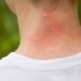 Verão a vista pede truques caseiros para afastar mosquitos e pernilongos para não correr riscos