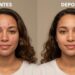 O que realmente funciona contra acne, segundo uma especialista em pele