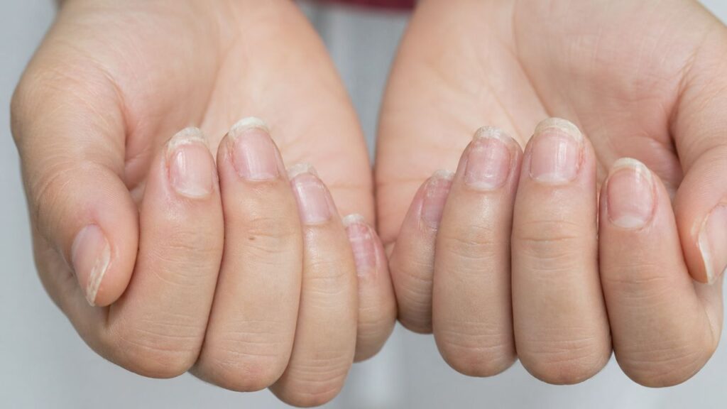 Deficiência de ferro: 3 sinais no corpo que aparecem no espelho e quase ninguém percebe